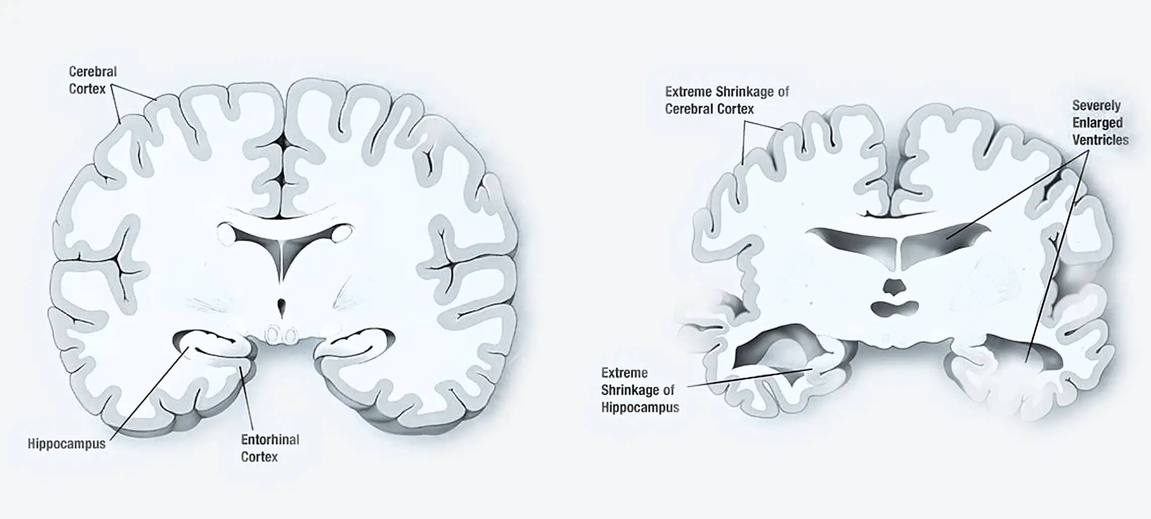 A comparison of a healthy brain and one affected by Alzheimer's disease